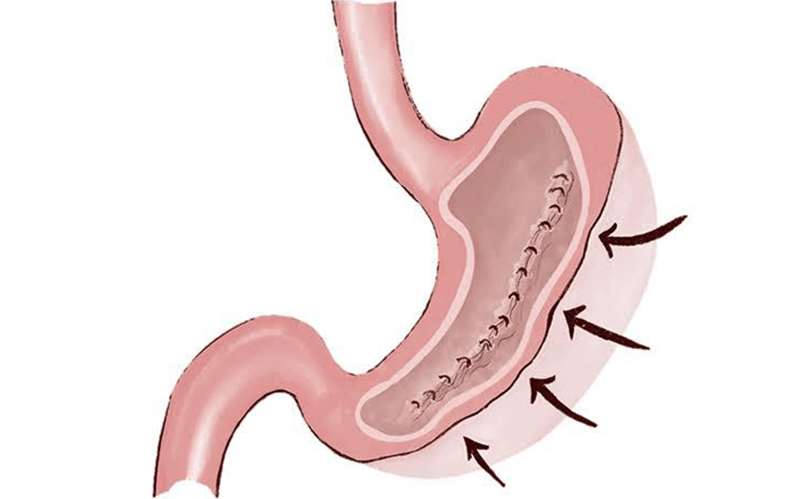 MANGA GÁSTRICA POR ENDOSCOPIA