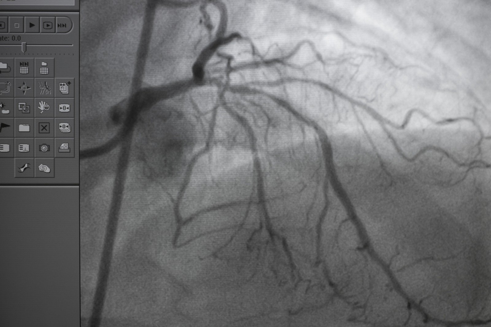ARTERIAS CORONARIAS