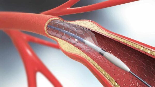 STENT CORONARIO